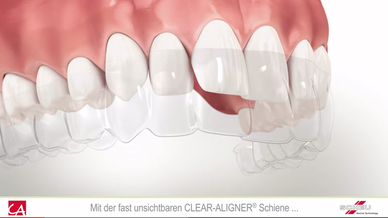 Info-Video zum Clear-Aligner Schienensystem